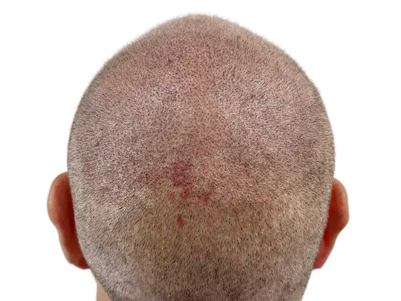 Hair thinning at crown. Possible hair transplant before. Scalp redness. Hair restoration services available.