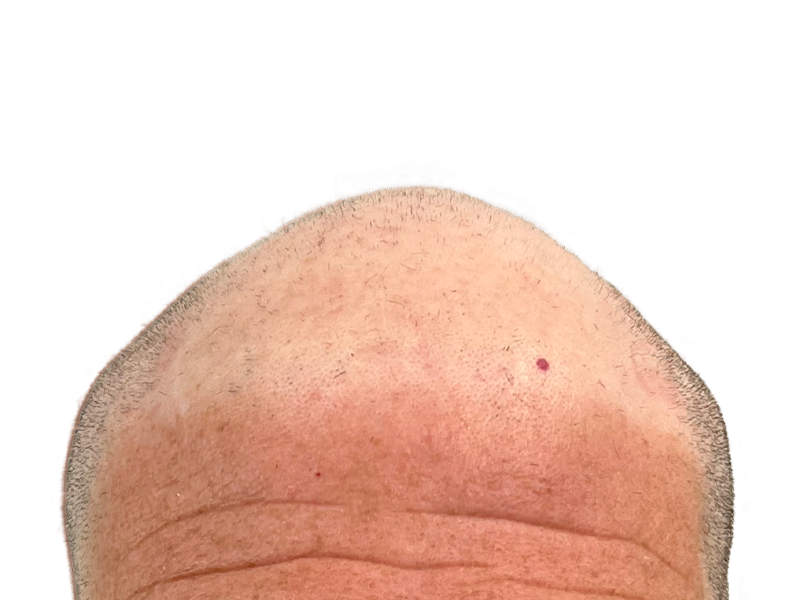 Thinning hair on light skin. Potential hair transplant candidate. Sparse hair suggests hair restoration options. Before/after results not shown.