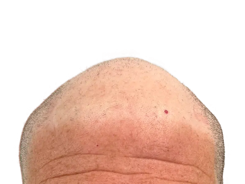 Thinning hair on light skin. Potential hair transplant candidate. Sparse hair suggests hair restoration options. Before/after results not shown.