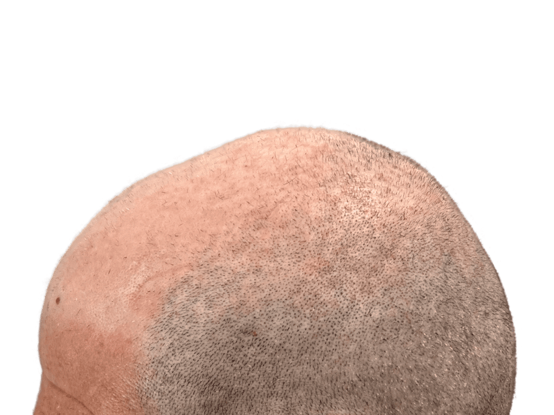 Receding hairline & thinning crown. Hair restoration/transplant result? Light skin, gray/brown hair. Before/after hair density visible.