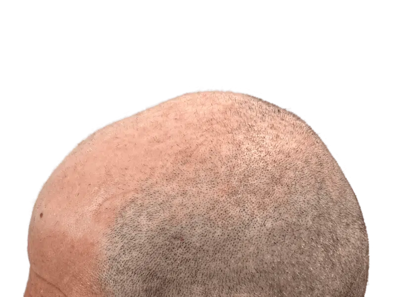 Receding hairline & thinning crown. Hair restoration/transplant result? Light skin, gray/brown hair. Before/after hair density visible.