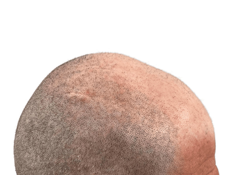 Hair transplant result: Sparse to denser hair. Scalp scar visible. Before & after hair restoration example.