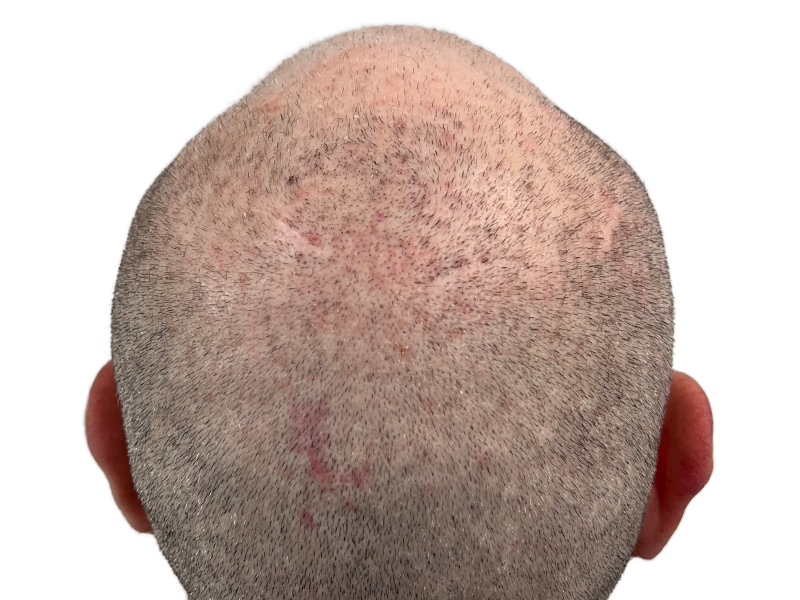 Hair transplant scar on thinning gray hair. Scalp visible. Hair restoration result. Before/after consideration.