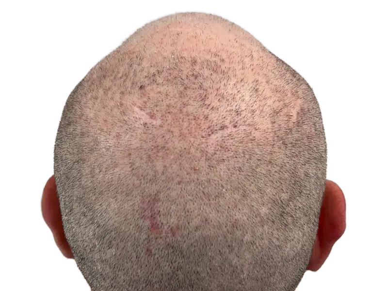 Hair transplant scar on thinning gray hair. Scalp visible. Hair restoration result. Before/after consideration.