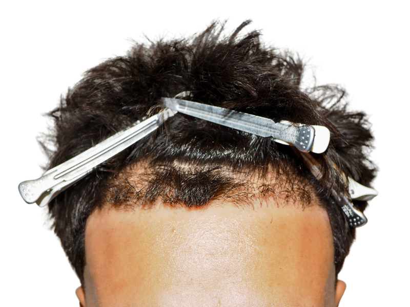 Hair transplant close-up: New hairline with clips. Hair restoration procedure in progress. Showing potential results.