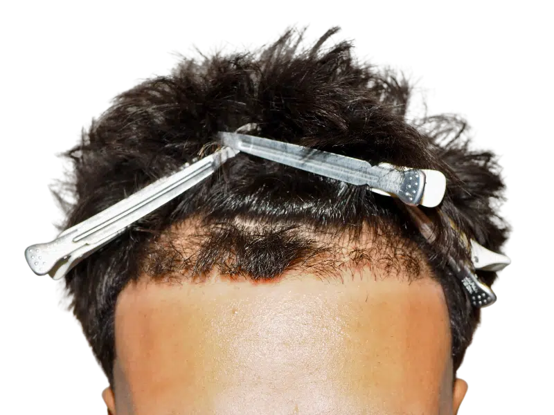 Hair transplant close-up: New hairline with clips. Hair restoration procedure in progress. Showing potential results.