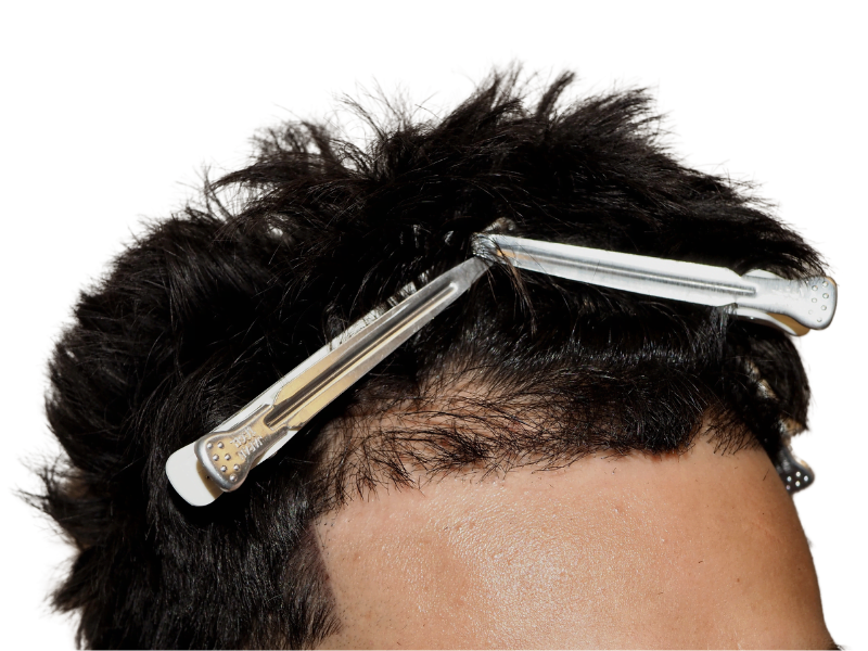 Close-up of hair with clips. Possible hair restoration or transplant evaluation. Before/after comparison potential.