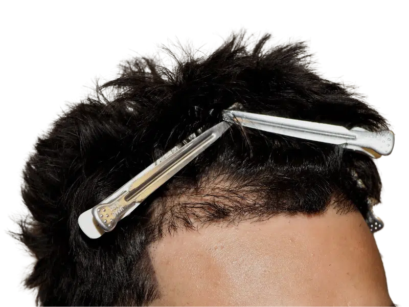 Close-up of hair with clips. Possible hair restoration or transplant evaluation. Before/after comparison potential.