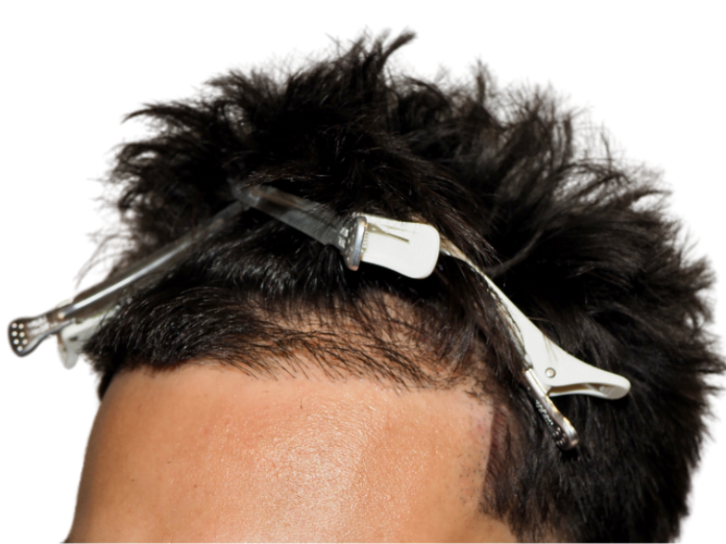 Hair transplant close-up: Dense, dark hairline after restoration. Hair clips hold hair. Shows procedure results.