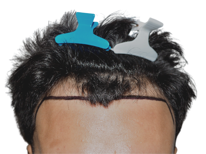 Asian man's hairline marked before hair transplant. Shows planned hair restoration procedure. Before photo.
