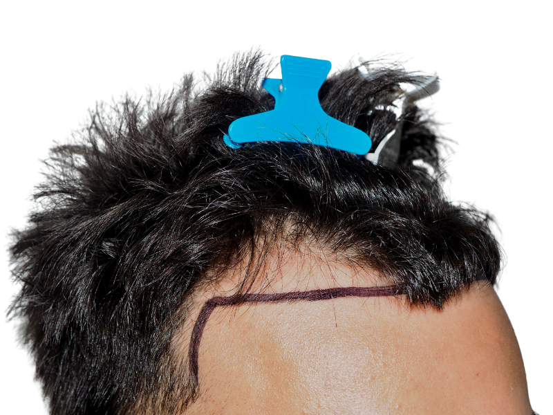Before hair transplant: Marked hairline for restoration. Dark hair, light skin. Shows planned procedure area.