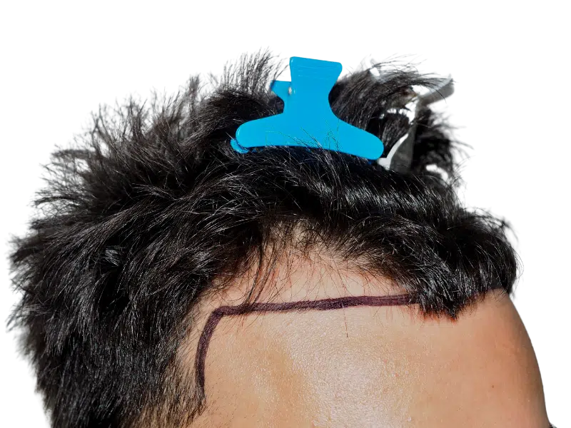 Before hair transplant: Marked hairline for restoration. Dark hair, light skin. Shows planned procedure area.