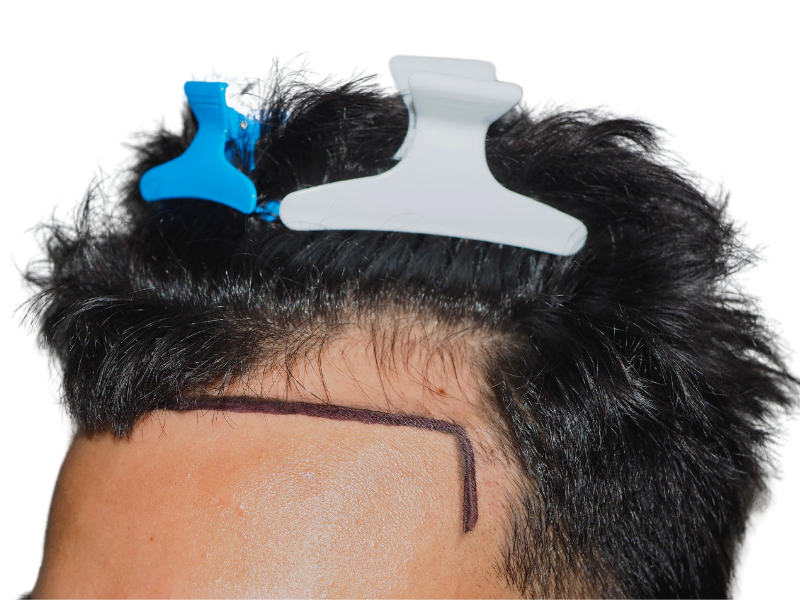 Hair transplant prep: Marked hairline on forehead before hair restoration procedure. Hair clips in place. Before treatment.