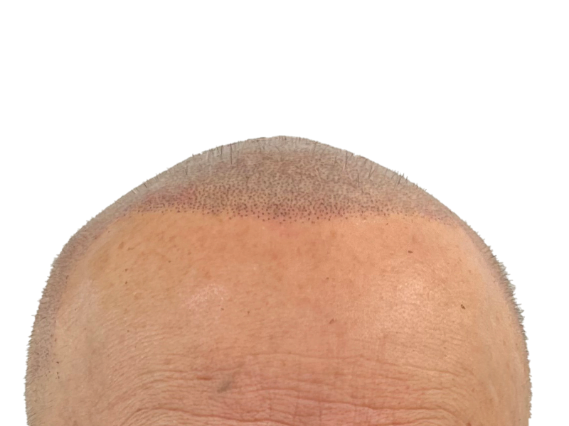 Hair transplant result: New hairline with implanted follicles. Early hair growth visible. Hair restoration success.