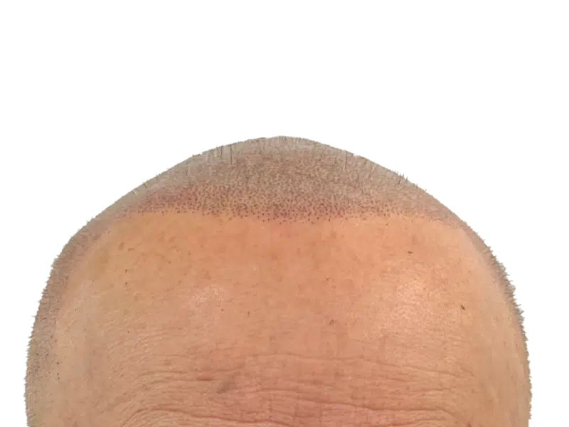Hair transplant result: New hairline with implanted follicles. Early hair growth visible. Hair restoration success.