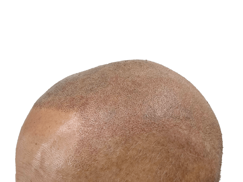 Hair transplant close-up: Light skin, newly transplanted follicles visible. Hair restoration results. Scalp detail.