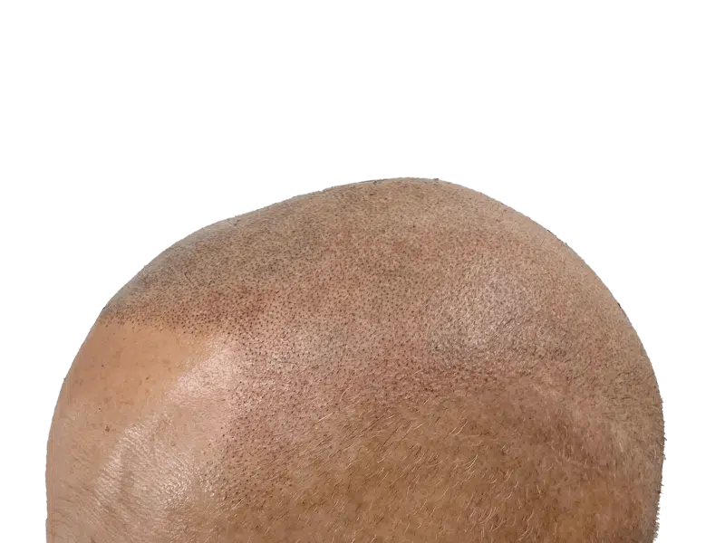Hair transplant close-up: Light skin, newly transplanted follicles visible. Hair restoration results. Scalp detail.