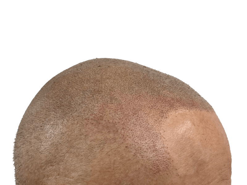 Hair transplant result: Light brown skin, improved hair density on top of head. Before/after hair restoration.