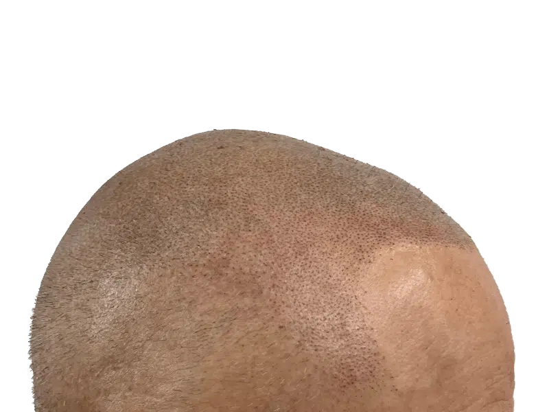 Hair transplant result: Light brown skin, improved hair density on top of head. Before/after hair restoration.