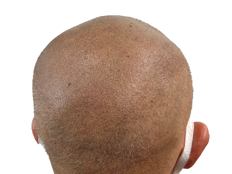 Hair transplant result: Evenly distributed, short hair growth on light skin. Hair restoration density achieved.