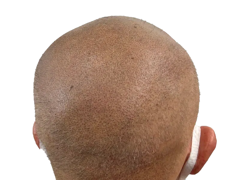 Hair transplant result: Evenly distributed, short hair growth on light skin. Hair restoration density achieved.