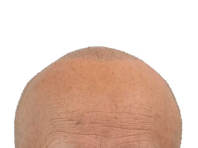 Balding head. Potential hair loss candidate. Consider hair restoration options like hair transplant procedures.