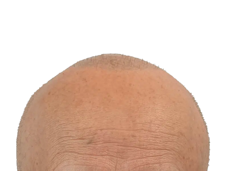 Balding head. Potential hair loss candidate. Consider hair restoration options like hair transplant procedures.