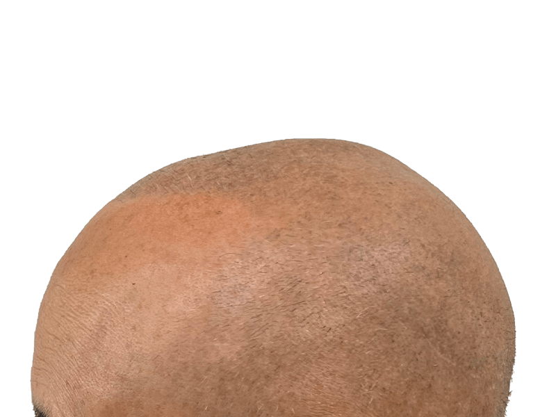 Hair restoration: Close-up of scalp showing fine hair growth. Possible hair transplant result. Light brown skin tone.
