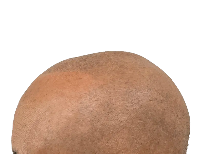 Hair restoration: Close-up of scalp showing fine hair growth. Possible hair transplant result. Light brown skin tone.