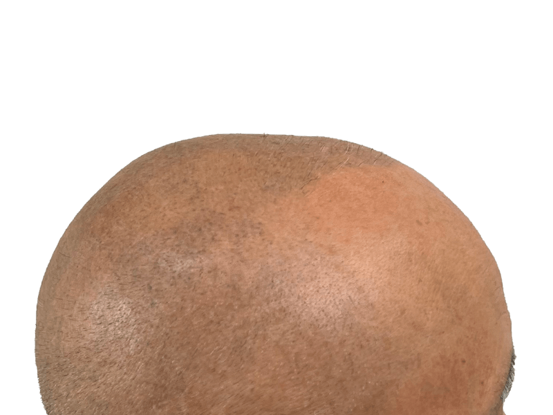 Thinning hair close-up. Possible hair transplant before/after. Hair restoration results. Receding hairline visible.