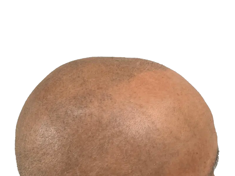 Thinning hair close-up. Possible hair transplant before/after. Hair restoration results. Receding hairline visible.