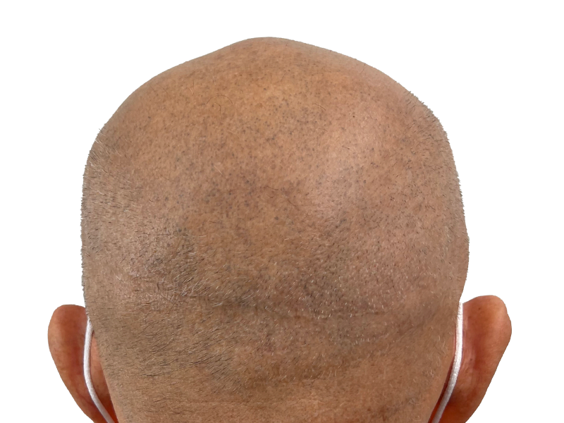Before hair transplant: Balding African American man. Consider hair restoration options for similar results.