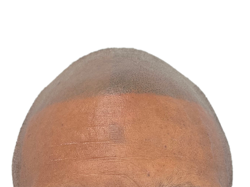 Hair transplant result: Uniform hair density on a shaved head. Possible before/after of hair restoration procedure.
