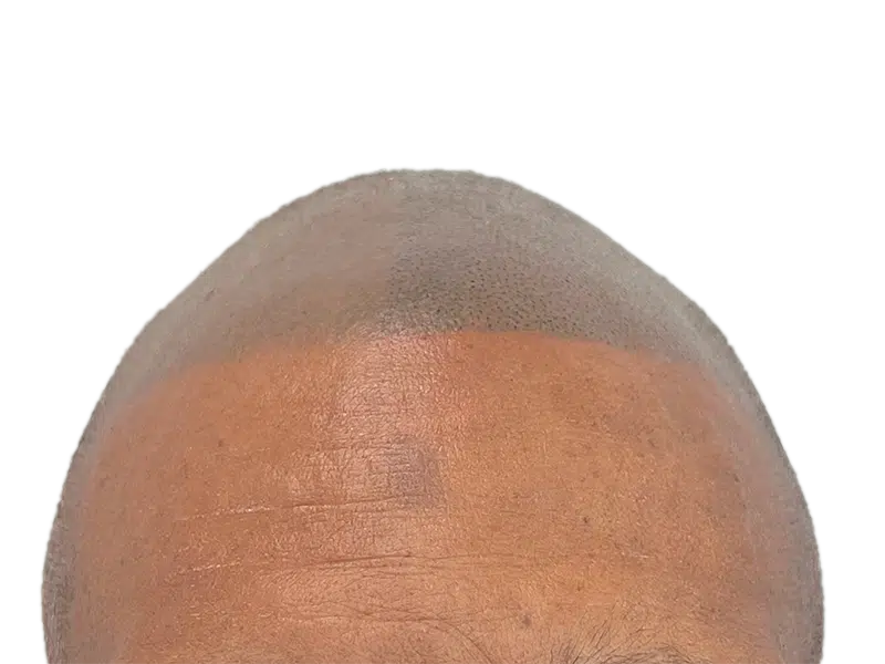Hair transplant result: Uniform hair density on a shaved head. Possible before/after of hair restoration procedure.