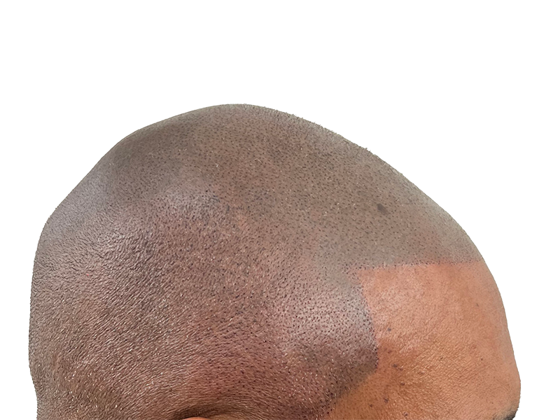 Hair transplant result on African American man. Bald spot with follicle implants. Hair restoration success.
