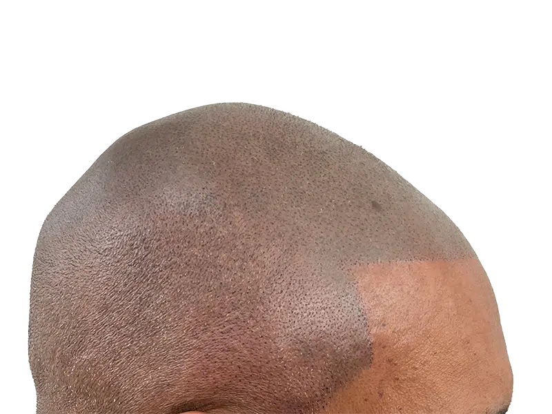 Hair transplant result on African American man. Bald spot with follicle implants. Hair restoration success.