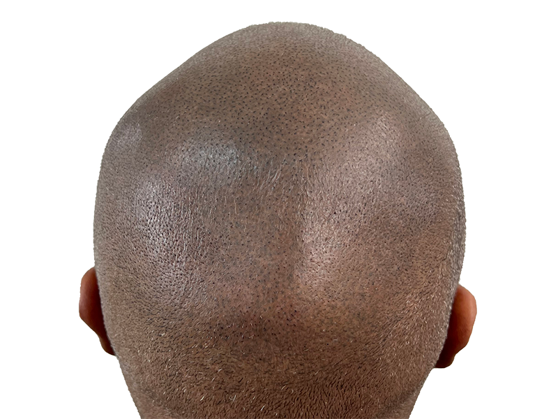 Hair transplant result: Back of head showing fuller, tightly coiled hair after restoration procedure. Before/after visible.