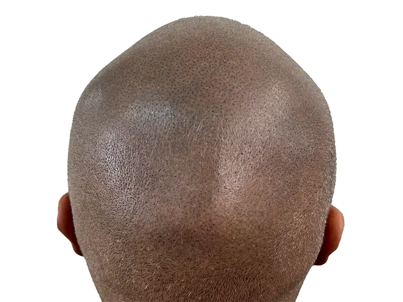 Hair transplant result: Back of head showing fuller, tightly coiled hair after restoration procedure. Before/after visible.