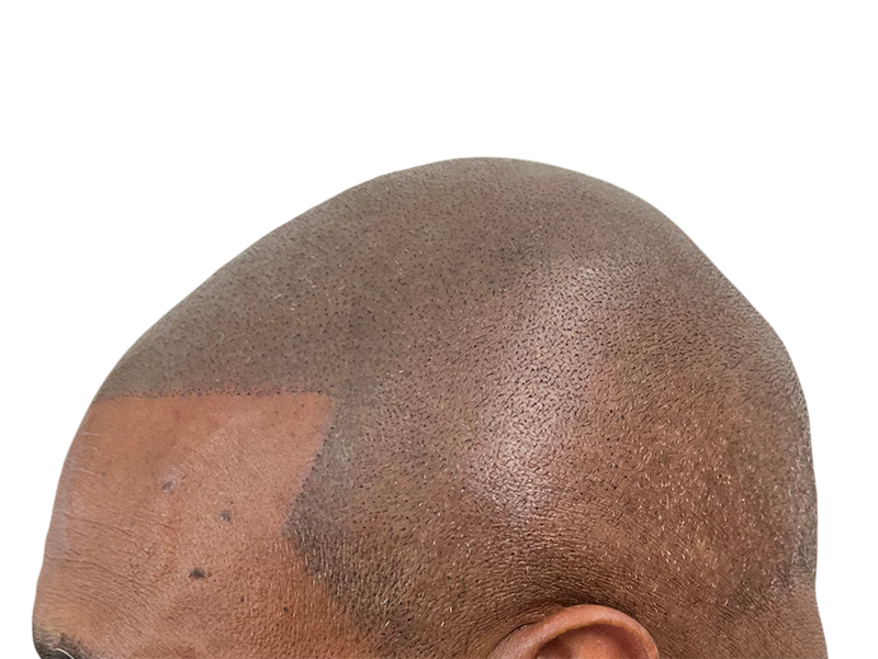 Hair transplant results: Before/after showing improved density on a shaved head. Hair restoration success.