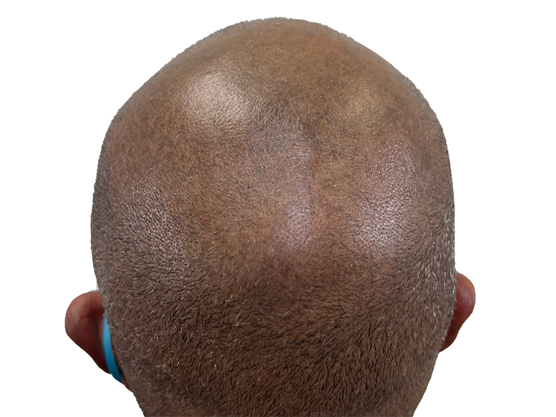Before hair transplant: Close-up of scalp showing thinning hair. Hair restoration procedure candidate.