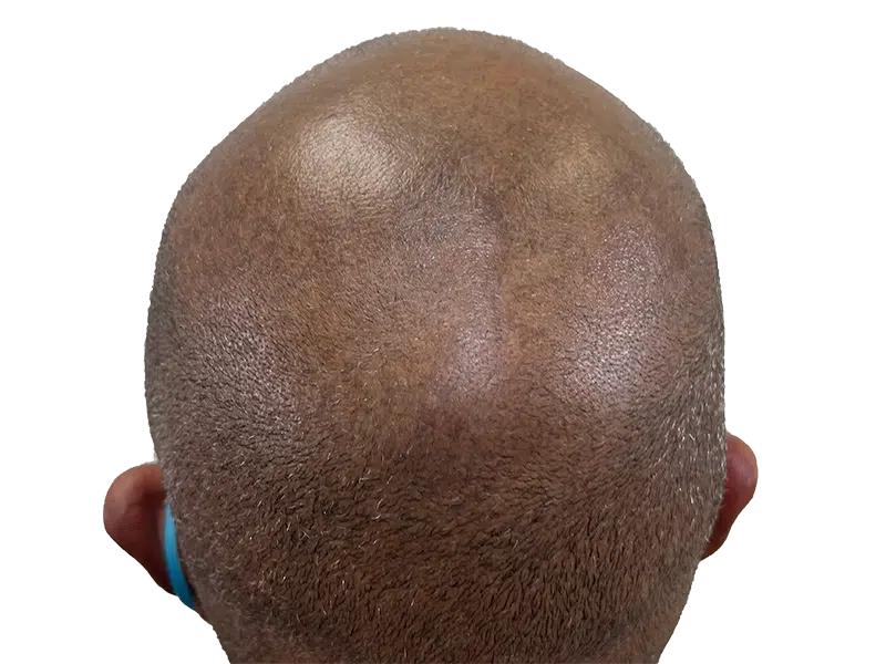 Before hair transplant: Close-up of scalp showing thinning hair. Hair restoration procedure candidate.
