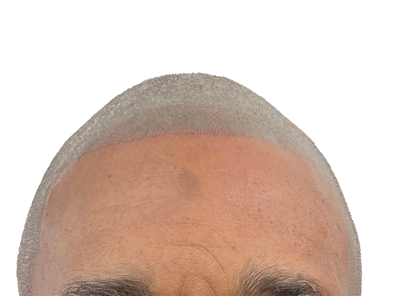 Hair transplant result: Defined hairline on man with thinning crown. Hair restoration before & after example.