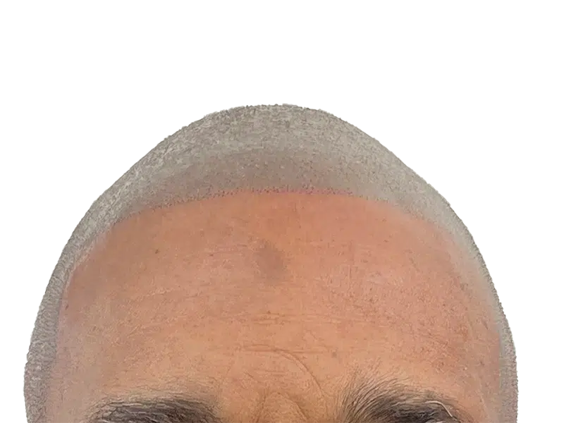 Hair transplant result: Defined hairline on man with thinning crown. Hair restoration before & after example.