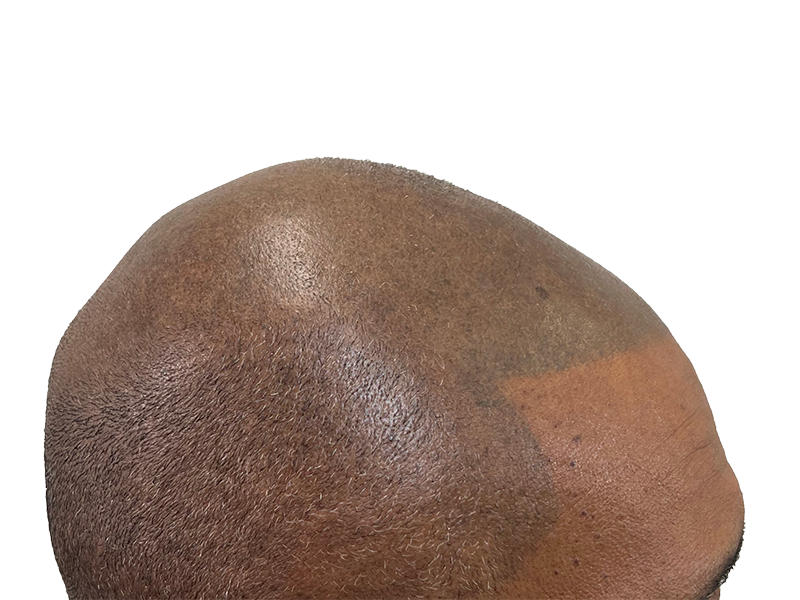 Hair transplant result: Restored hair density on scalp. Noticeable improvement in coverage and texture. Hair restoration success.