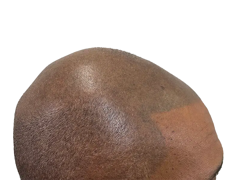 Hair transplant result: Restored hair density on scalp. Noticeable improvement in coverage and texture. Hair restoration success.