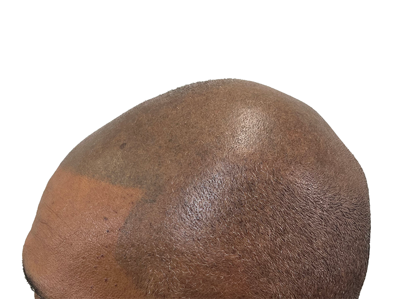 Hair transplant result: Close-up of scalp showing restored hair density. Note lighter skin patch from procedure. Before/after visible.