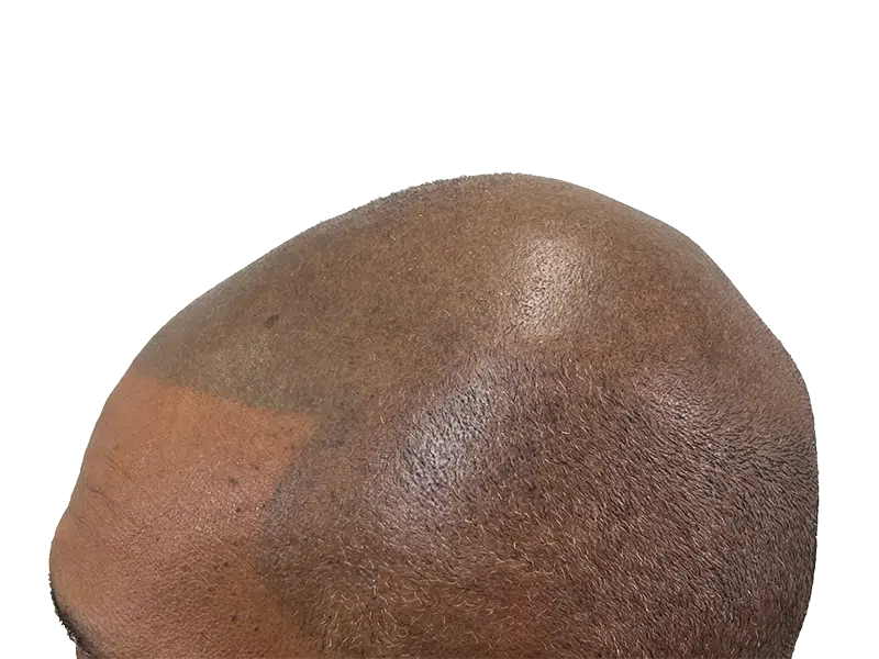 Hair transplant result: Close-up of scalp showing restored hair density. Note lighter skin patch from procedure. Before/after visible.