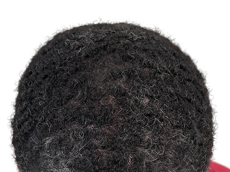Dense, dark curly hair. Potential hair restoration candidate. No visible hair transplant work. Before treatment example.