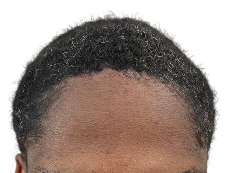Receding hairline before hair transplant. Hair restoration for fuller, natural-looking results. Before procedure.