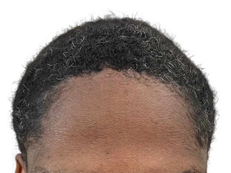 Receding hairline before hair transplant. Hair restoration for fuller, natural-looking results. Before procedure.